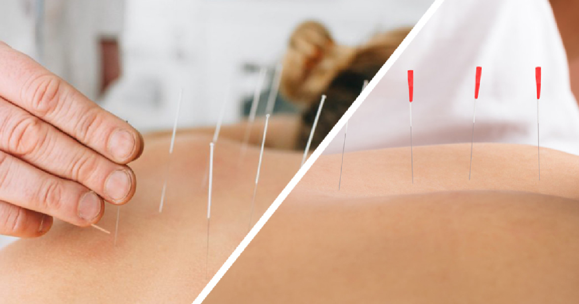 ایکیوپنکچر کیا ہے اور کینسر کے مریضوں کے لیے کیسے مددگار ہے؟