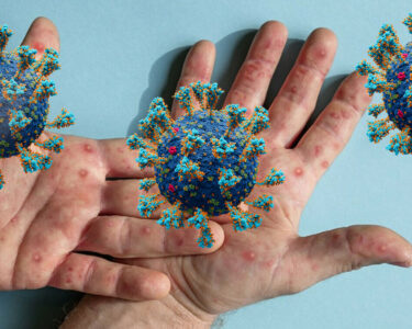 چیچک کا وائرس عالمی وبا پھیلنے کا اندیشہ