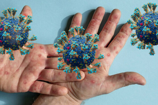 چیچک کا وائرس عالمی وبا پھیلنے کا اندیشہ