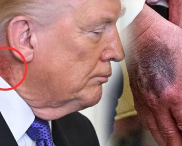 امریکی صدر ڈونلڈ ٹرمپ کے جسم پر نشانات