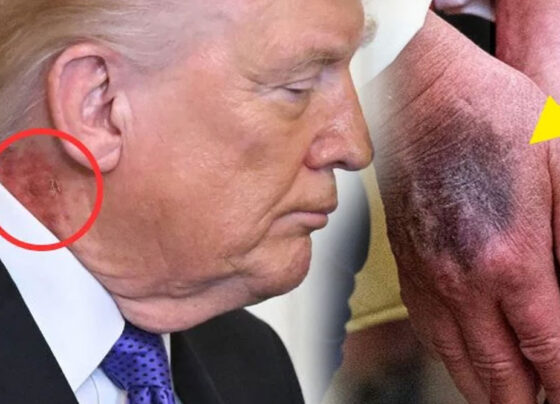 امریکی صدر ڈونلڈ ٹرمپ کے جسم پر نشانات