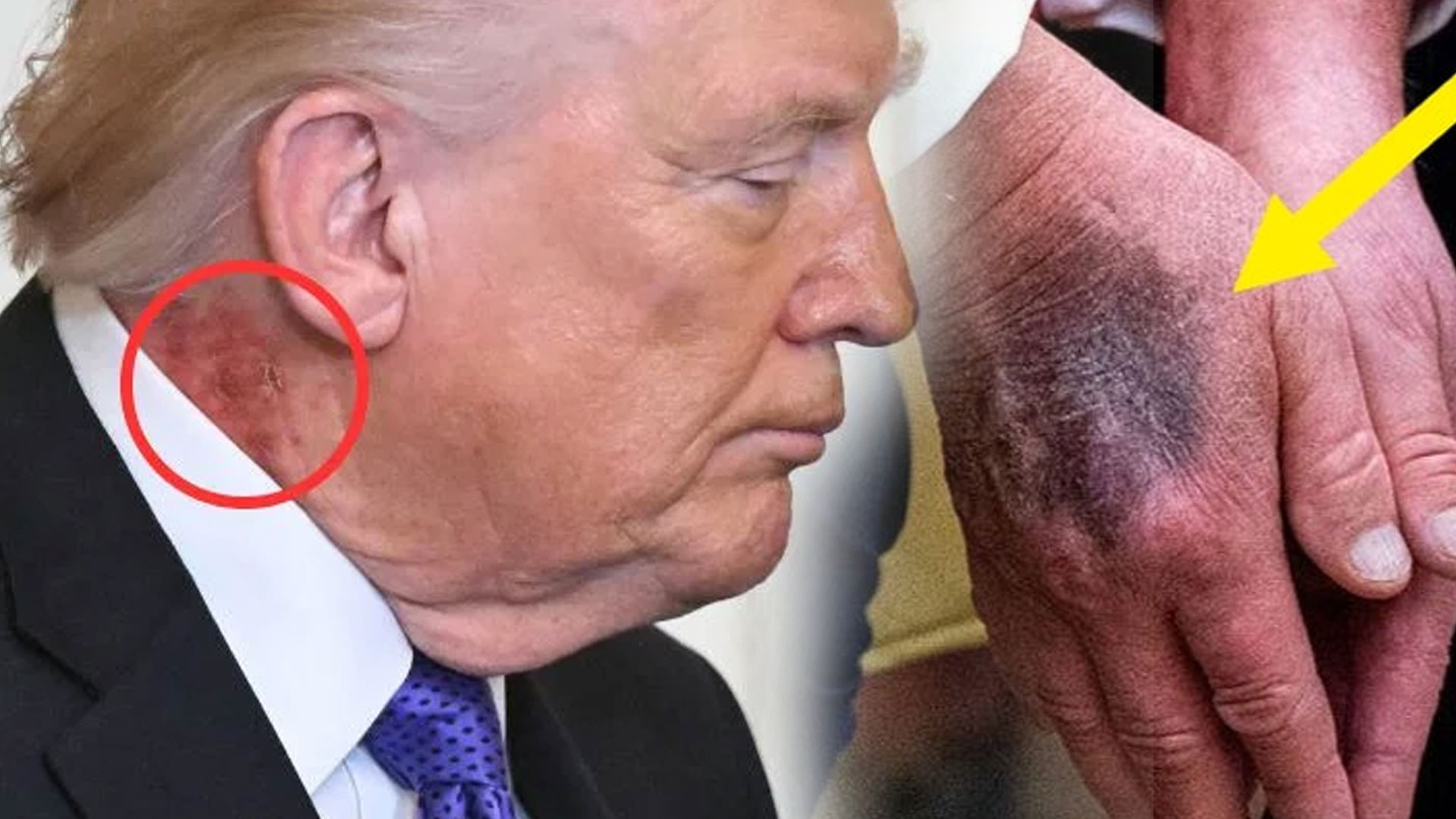 گردن اورہاتھ پراچانک سرخ اور کالے نشانات نمودار، صدرڈونلڈ ٹرمپ کی صحت سے متعلق ہلچل، وائٹ ہاؤس کی وضاحت