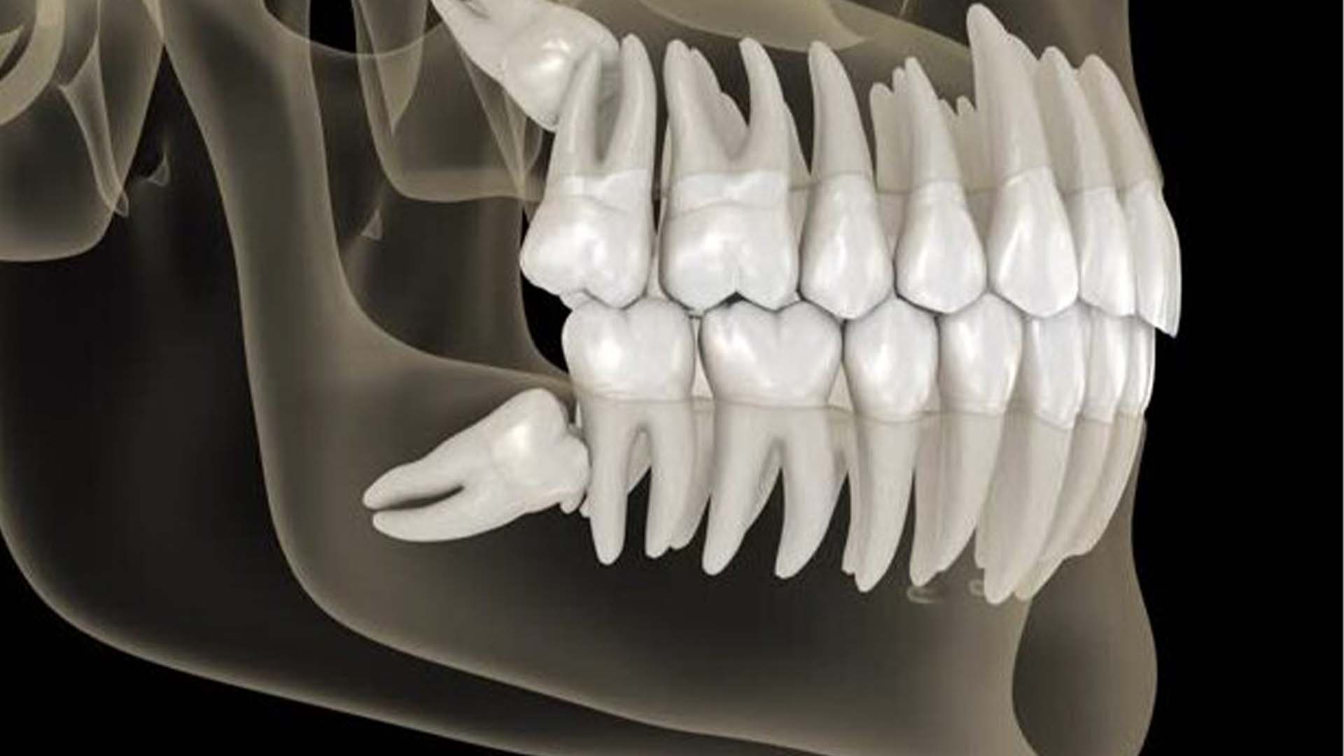 ویسٹم ٹوتھ اب فضول نہیں، طبی سائنس میں بڑا انکشاف