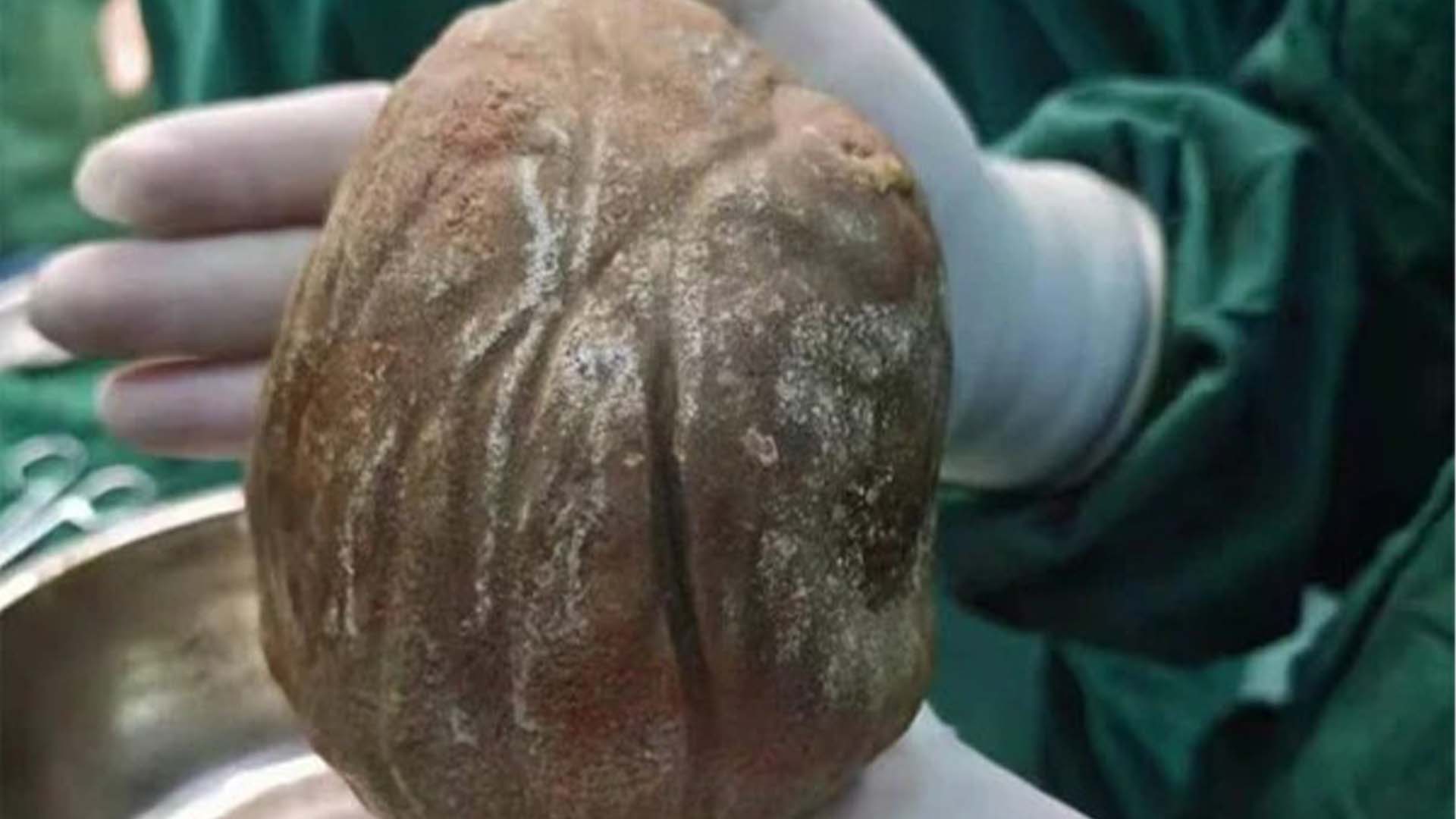 مثانے سے نکلی 1.3 کلو وزنی پتھری,حیرت انگیز سرجری