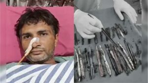حیران کن طبی کیس، نوجوان کے معدے سے ٹوتھ برش اور لوہے کے اوزار برآمد