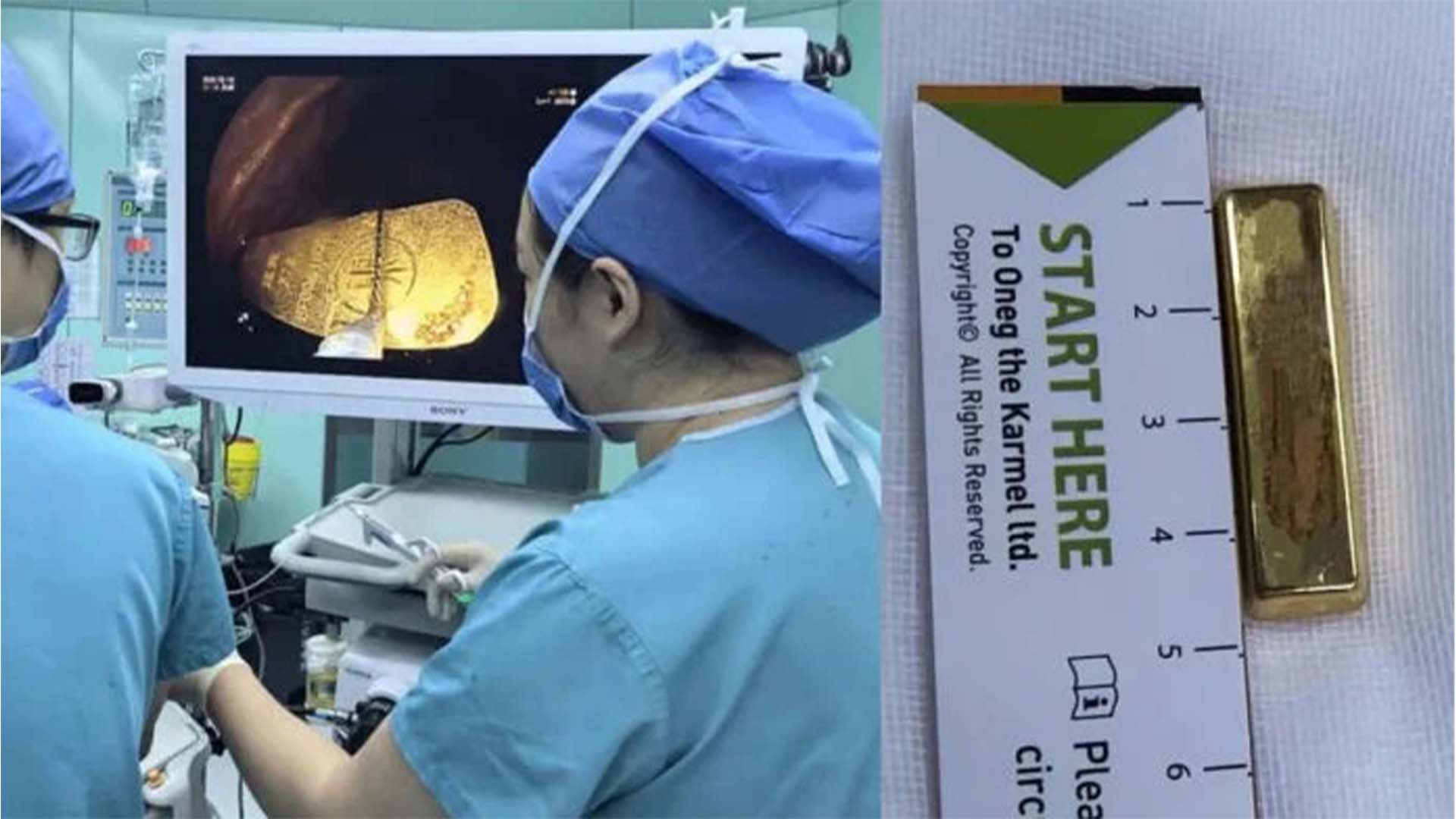 چین میں حیران کن واقعہ، 5 سالہ بچی کے معدے سے سونے کا بار برآمد
