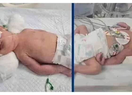 جڑواں بچوں کی پیدائش