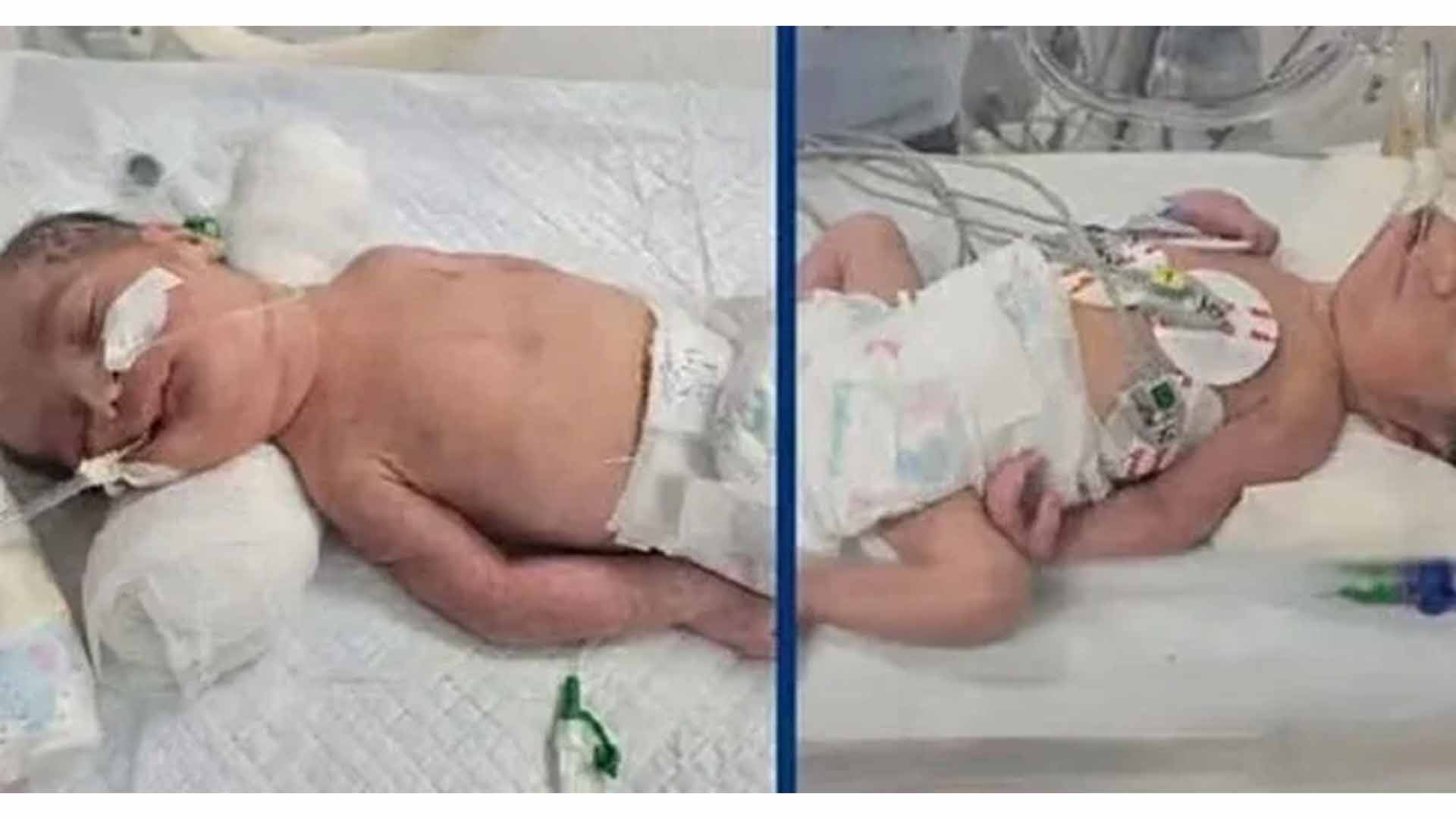 ماں کی موت کے 20 منٹ بعد جڑواں بچوں کی زندہ پیدائش، حیران کن واقعہ